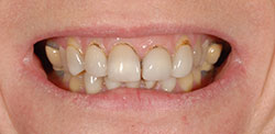 teeth-example